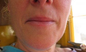 Anti-Aging Radiesse Before