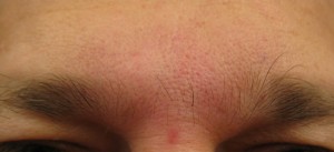 Botox Cosmetic Frown Lines - After