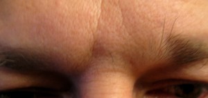 Botox Cosmetic Frown Lines - Before