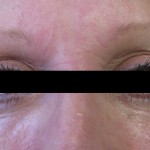 Correction of Under Eye Fat Pads with Radiesse