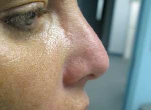 Non-Surgical Nose Reshaping After