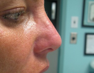 Non-Surgical Nose Reshaping Before