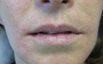 Correction of Mild Nasolabial Folds and Marionette Lines