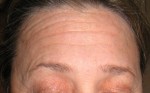 Forehead Wrinkles Before