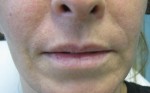Before Mild Nasolabial Folds and Marionette Lines