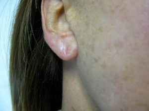 Correction of Thinning Earlobe with Radiesse Treatment 