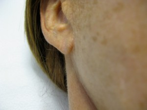 Thinning Earlobe before Radiesse Treatment