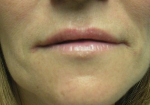 Full  Lips with Youthful Corners Post Juvederm Treatment 