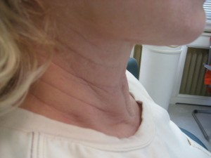 Sagging Neck Before Botox Treatment