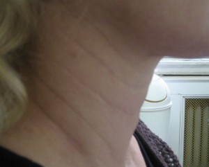 Partial Correction 1 Week Post Botox Treatment