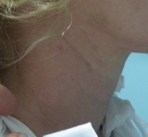 Full Correction of Sagging Neck 3 Weeks Post Botox Treatment