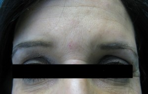 Correction of Deep Forehead Wrinkles Post Botox Treatment 