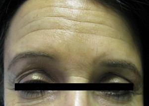 Deep Forehead Wrinkles Before Botox Treatment 