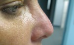 Before Non-Surgical Nose Reshaping