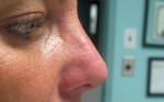 After Non-Surgical Nose Reshaping